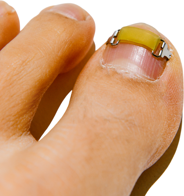 메디인랩 내성발톱 교정기 와이어 관리 도구 세트, 1세트