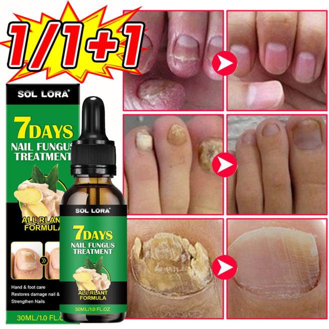 발톱 곰팡이 솔루션 문제성발톱 앰플 한번에끝내는 손발톱 영양제 보장증정, 1개, 30ml