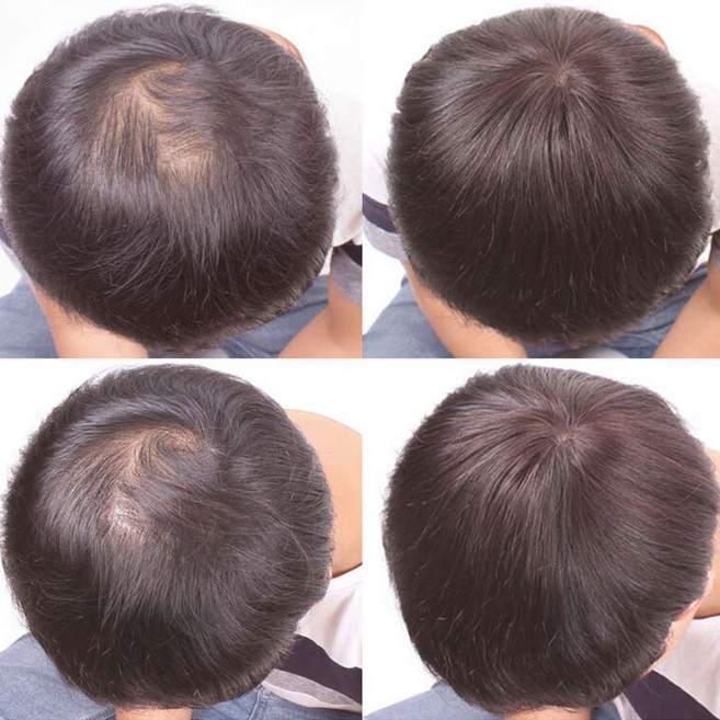 남자 인모 볼륨 똑딱이 고정 탈모 부분 정수리 가발 자연검정