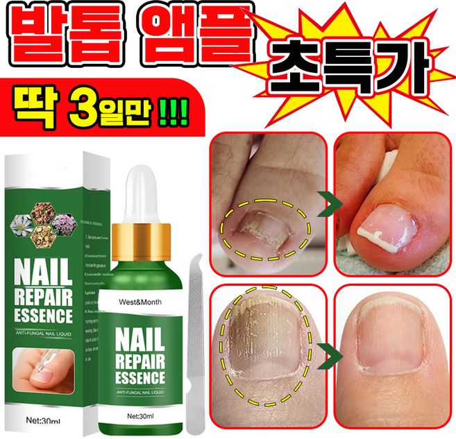 발톱 앰플 솔루션 문제성발톱 영양제 발톱 공팡이 한번에끝내는 손발톱 연화제, 1개, 30ml