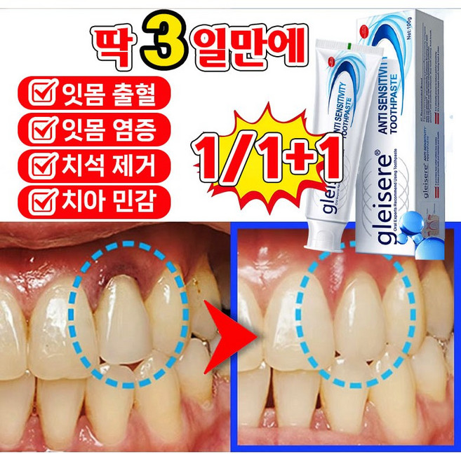 [예방 및 관리 효과!!!] 잇몸 재생 치약 치아 미백 치약 치주염 잇몸 붓기 염증 입냄새 치석제거 구취케어 약구전용 포장 랜덤 증정, 3개, 100g