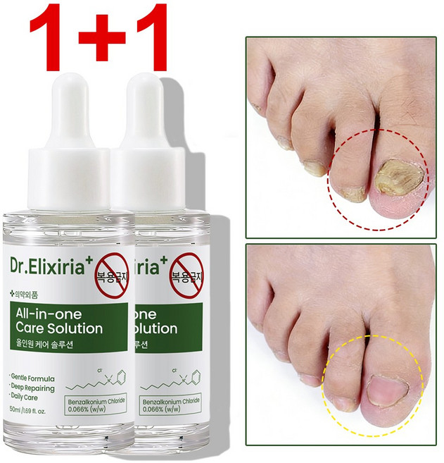 문제성발톱 앰플 손 발톱 영양제 관리 앰플 발톱 곰팡이 리페어 세럼 발바닥 발가락 풋케어 솔루션, 2개, 50ml