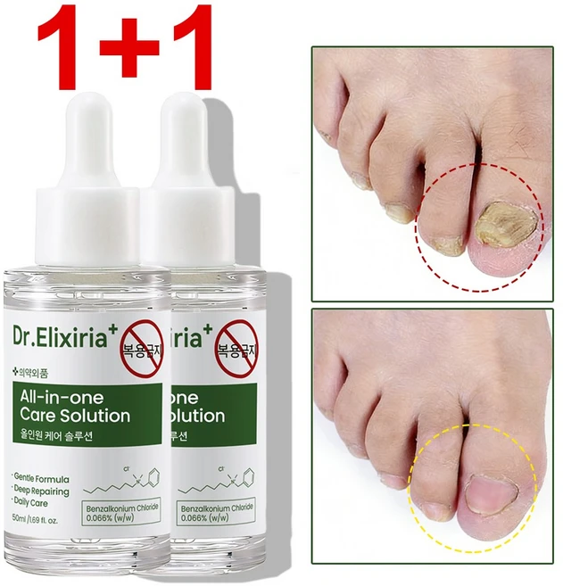 문제성발톱 앰플 손 발톱 영양제 관리 앰플 발톱 위생 케어 세럼 발바닥 발가락 풋케어 솔루션, 2개, 50ml - 쿠팡