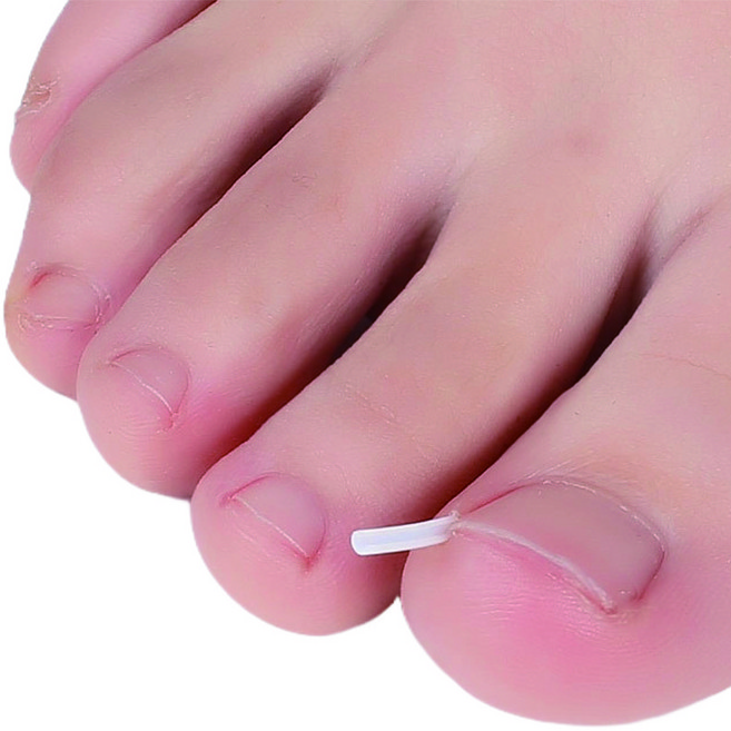 싱글레이드 찌르는 내성 발톱 자가 케어 셀프 팁, 1개