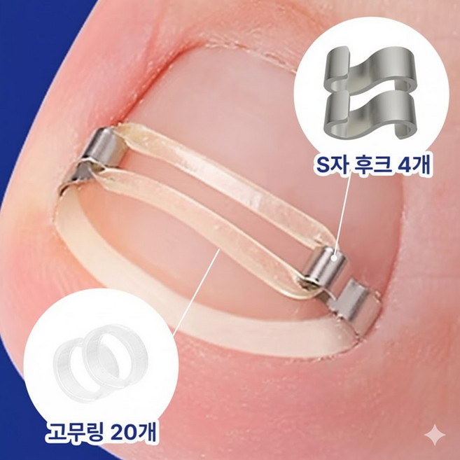 정승프로덕츠 파고드는 발톱 홈케어 와이어 리프터 관리기, 1세트