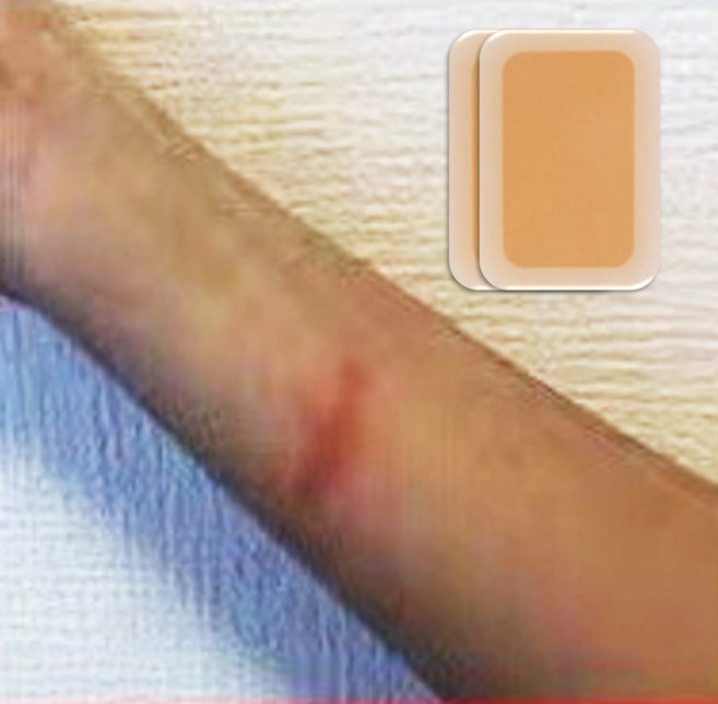 튼살커버 자해흉터가리기 멍패치 2p 살색파스 점커버 멍커버 백반증커버제, 1개, 다크