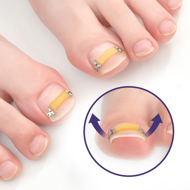 퍼펙토 내성발톱 교정기 플렉스트립 툴세트 파고드는 내향성 발톱 자가치료 의료기기, 1세트