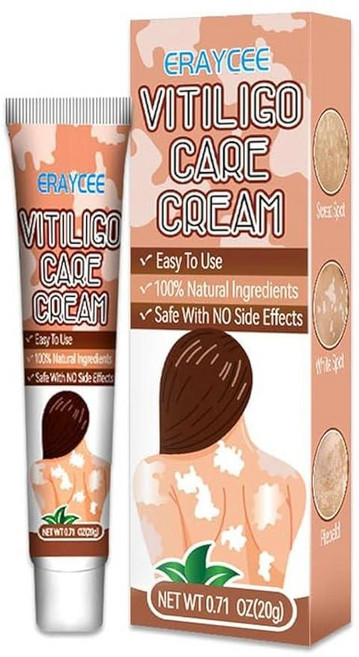 Vitiligo 크림 흰 반점을 줄이고 피부 색소 침착 개선 효과적인 백반증 트리트먼트 [호환], Vitiligo 크림, 흰 반점을 줄이고 피부 색소 침, 1개