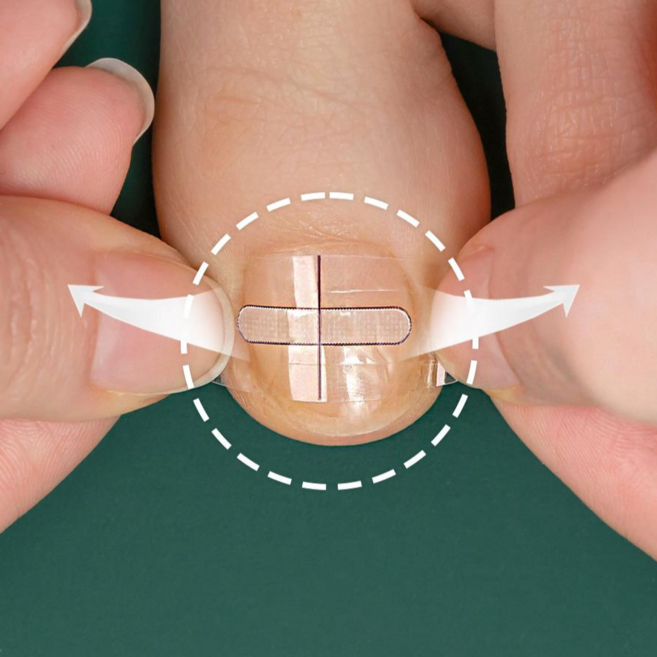 10매+10매 퍼펙토 내성발톱 교정기 스트립 교정팁 의료기기 자가치료 세트, 20개