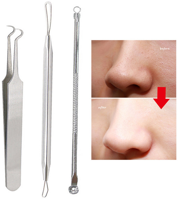 도구 블랙헤드 얼굴 추출기 클리너 리무버 점 여드름 스푼 검은 모공 청소용 여드름 도구 코메돈 바늘, [02] BA4 B298 BA17, 1개