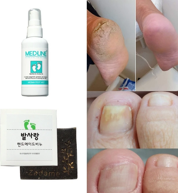 프리미엄 천연 문제성 발 약 스프레이 + 발비누 세트 무좀 패키지 화학성분 0%, 천연 풋 미스트+천연 수제 발비누 세트, 1개 - 쿠팡