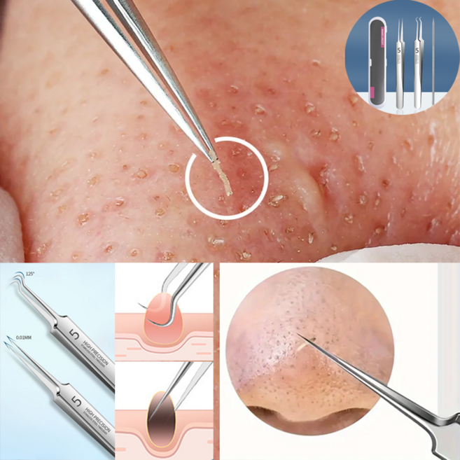 여드름 쏙쏙! 피지압출기, 4개, 일자형만