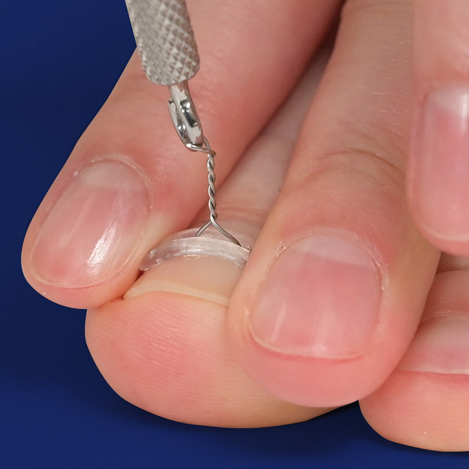 퍼펙토 픽스 내성발톱 교정기 와이어 의료기기 파고드는 발톱 자가치료 후크 세트, 1세트