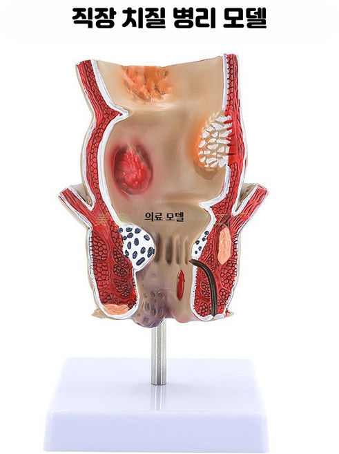 인체 치질 모형 직장 항문외과 해부학 병리학 A형 1피스 치질 모델, 1개