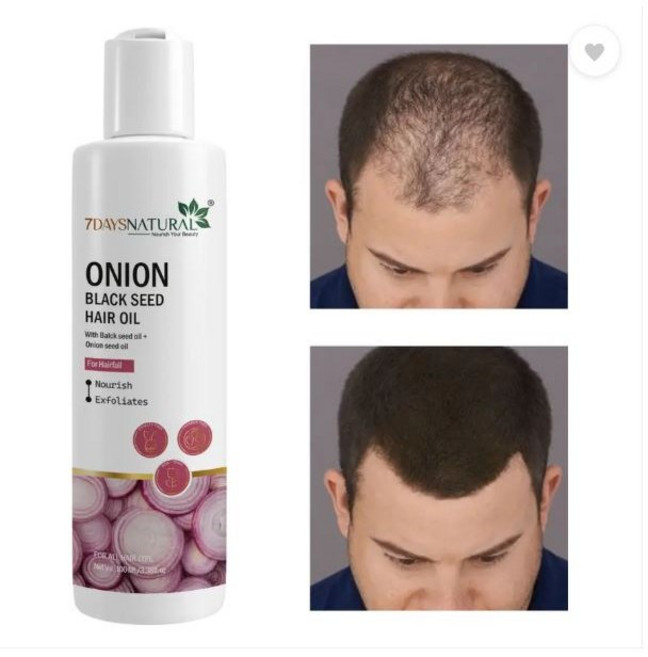 7days natural Onion Hair Growth Oil With Black seed For anti hair fall dandruff Hair Oil, 1개, 100ml