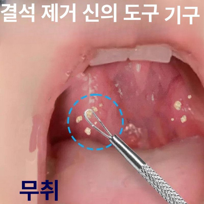 셀렉트하루 셀프편도결석제거기 구강관리 흡입기 치석, 3개 세트 석재 제거 도구, 기본 모델명/품번