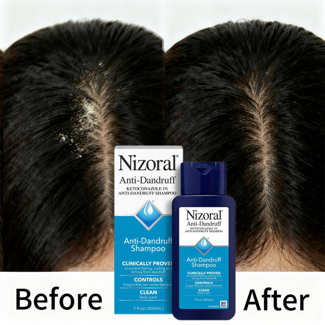 지루성 두피염 샴푸 비듬 샴푸 99.9% 비듬균 제거 비듬완화지속 비듬샴푸 두피가려움 남자 비듬샴푸 1위 여자 비듬샴푸 1위 약산성샴푸, 200ml, 2개
