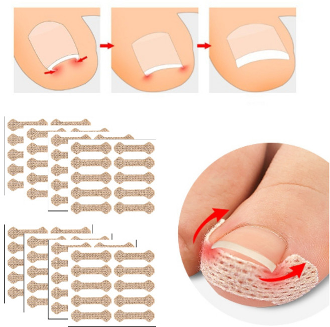 프리클라 발톱 패치 밴드 대용량 80p, 1개