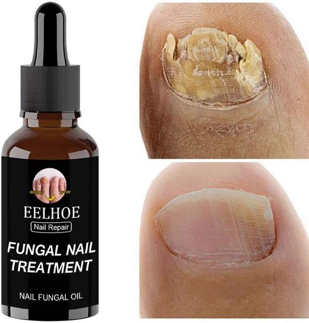 발톱 셀라 큐어 네일 조갑사상균증 리페어