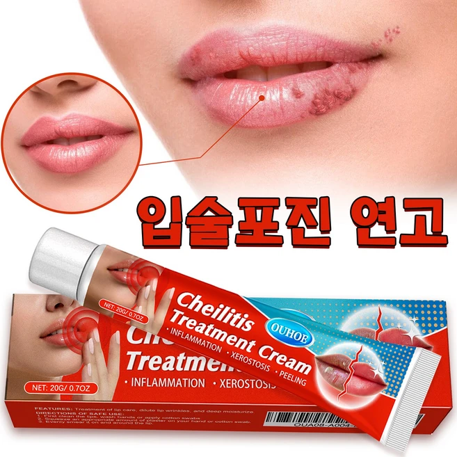천연 허브 성분/힐링 입술포진/입술부음 SM001, 2개, 20g, 무색무취. 색깔도 냄새도 없다. - 쿠팡