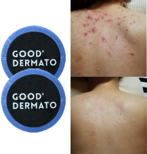 굿더마토 Mint for 데코르테 바디바 (등가슴 몸트러블 싹! 등드름 좁쌀 햇빛알러지 딥클렌징 천연수제비누 워시), 115g, 1개, 2개입