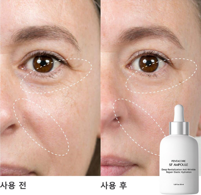 S-EGF 녹는실 리프팅 앰플 5F 리프팅 부스터 고함량 EGF 앰플 팔자주름 리프팅 PDRN 엑소좀앰플 EGF 고함량 비타민C 부스팅 앰플 콜라겐 레티놀 펩타이드 영양 미백 앰플, 1개, 50ml