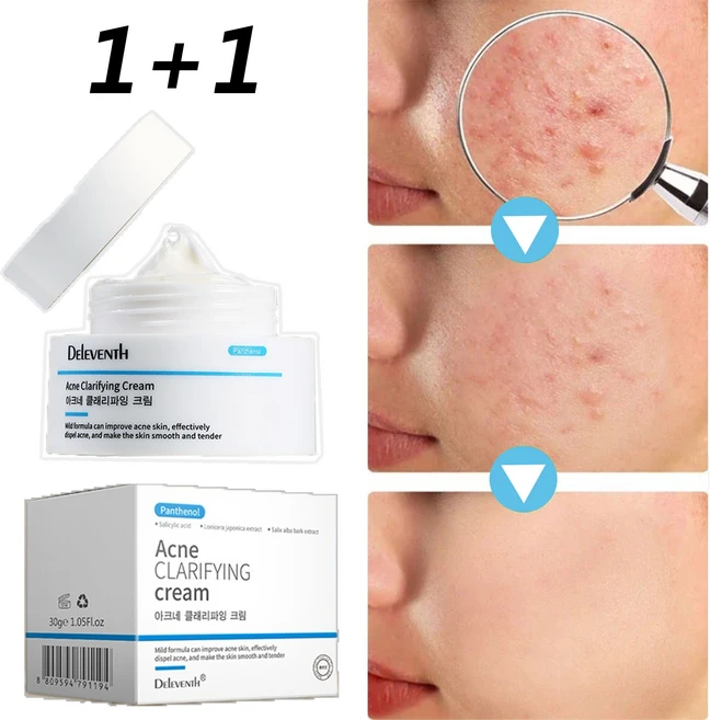 [제거효과 MAX]여드름 크림 천연 식물 성분 리페어 크림 민감피부 개선, 2개, 30g - 쿠팡