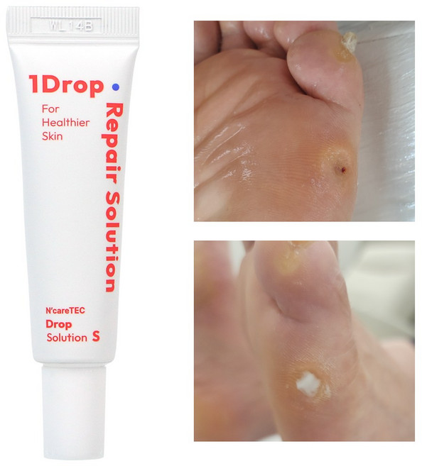 비오비오 스팟케어 티눈관리 문제성 손발톱 손톱영양제 트리트먼트 - 드롭 솔루션 S (10ml), 1개, 1개입