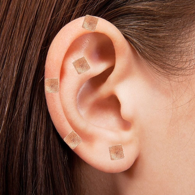 식욕억제침 귀지압 패치 점 귀침 혈자리 이침 이혈 테라피 기석