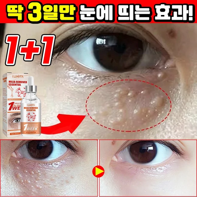 [효과보장] 1/1+1/2+2 눈밑 지방제거 에센스 비립종 제거 앰플 피부요철 각질제거 눈가주름 개선 다크서클 눈밑꺼짐 아이백 아이크림 LUPEIYA, 2개, 30ml - 쿠팡