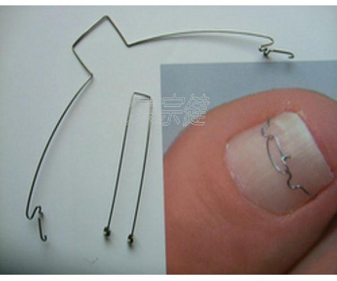 내성발톱 와이어 교정기 2개 자가 쉬운 셀프교정 툴 키트 파고드는 말린 엄지발톱, 1개