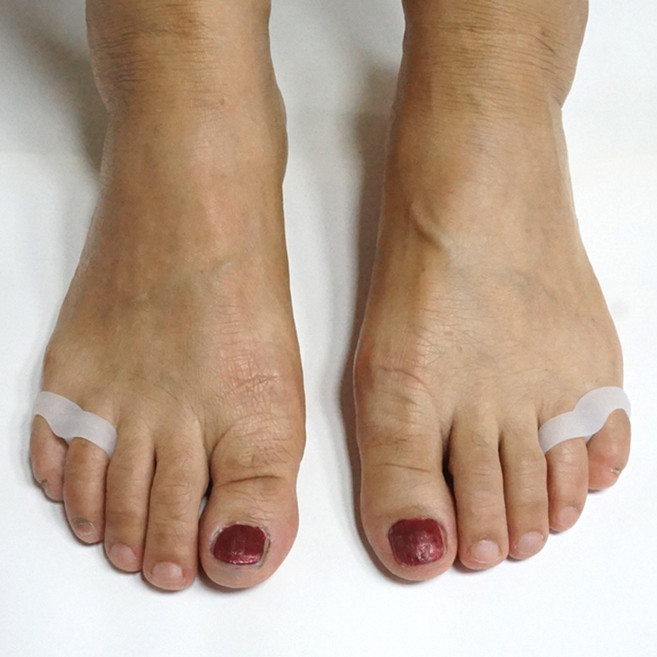 QueenZ 소건막류 교정기 새끼 발가락 분리 보호대 실리콘 6, 1세트