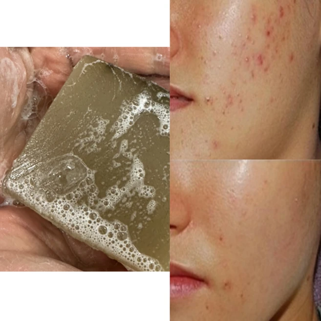 네이처레시피 딥클렌징 모낭충 비누 모냥염 비누 청소년 지루성 피부 수제비누, 100g, 1개입 - 쿠팡