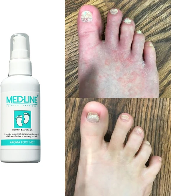 천연 문제성발 뿌리는 스프레이 무좀 세균 간지러움 각질 <망 증정>, 1개, 2개입 - 쿠팡