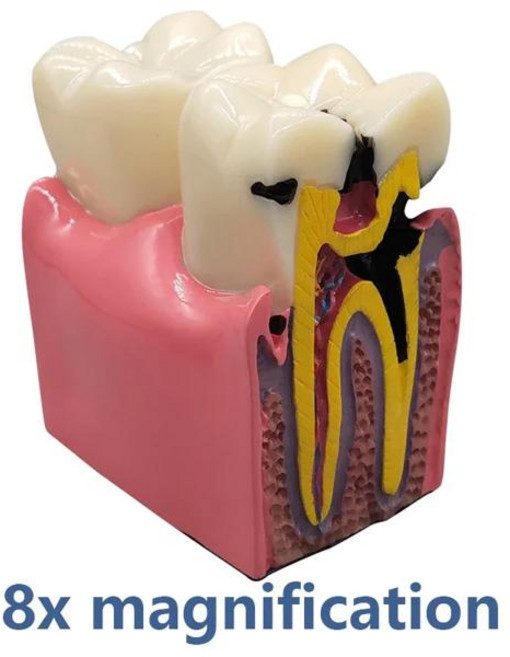8 배 치과 우식 모델 질병 치아 치과 데모 모델을 모델 의사 교육 실험실 구강 연구, [01] tooth model 8x