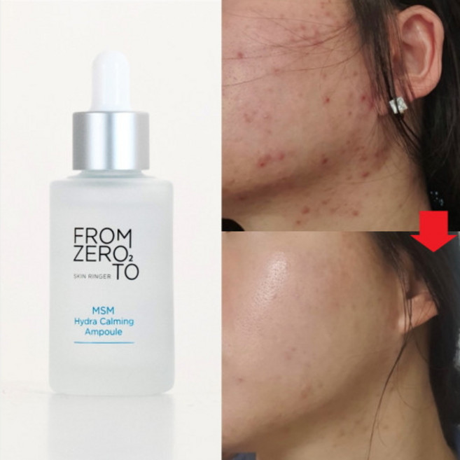 [프롬제로투] MSM식이유황 수분진정 세럼 에센스 앰플 35ml 접촉성 지루성 모낭 피부염 좁쌀 여드름 마스크트러블, 1개