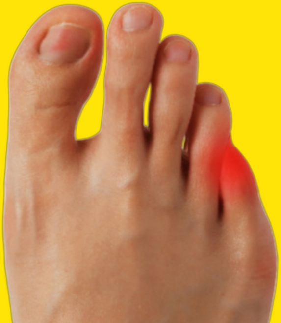 새끼발가락휨 소건막류 교정기 무지외반증 교정 운동 교정기, 2세트