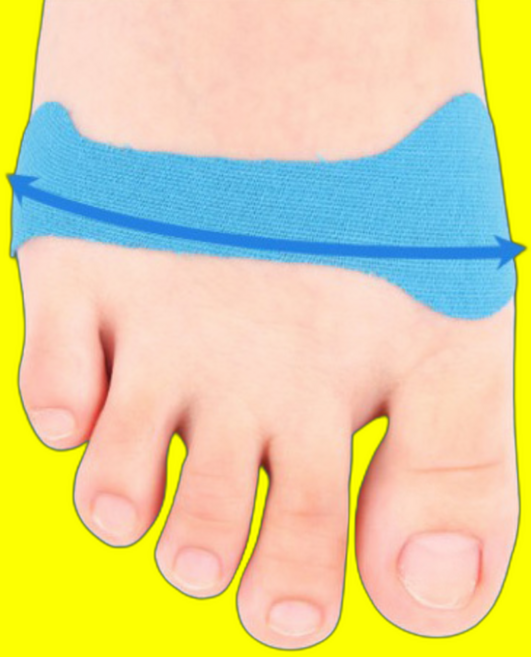 소건막류 교정기 소지내반증 소건막류신발 무지외반증테이핑 어린이무지외반증, 10개