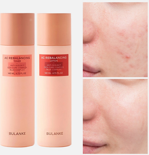 불란케 에이씨 리밸런싱 2종세트 청소년 사춘기 민감성 여드름 스킨로션, 1세트
