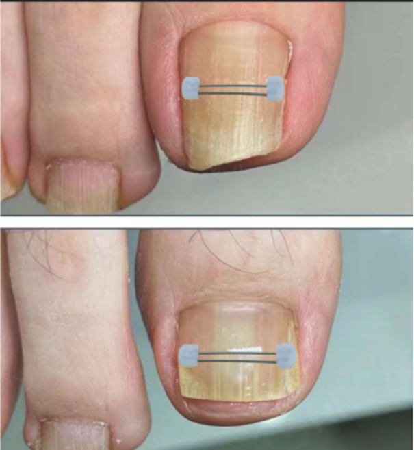 신짱 컴퍼니 파고드는 내성발톱 와이어 팁(10p)