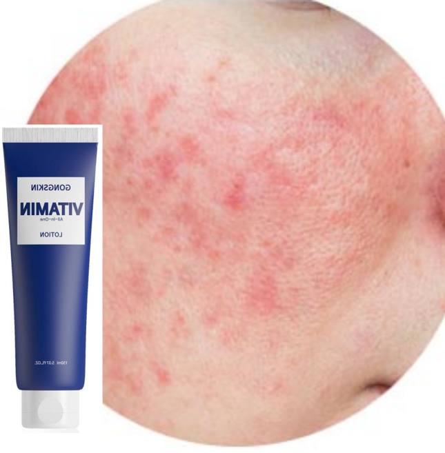 청소년여드름로션 사춘기로션 중학생기초화장품 중학생여드름화장품 초등학생여드름, 1개, 150g