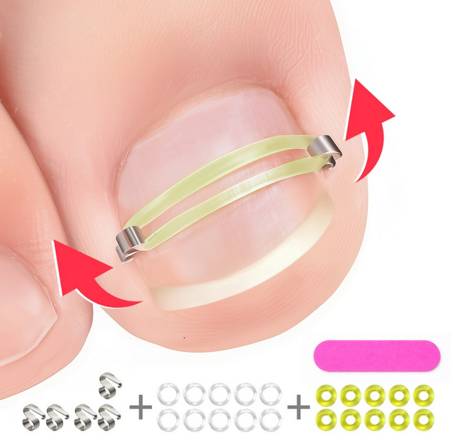 인생필품_설치쉬운 내성발톱 보호대_양발사용 수량+여분 팁1개, 1세트