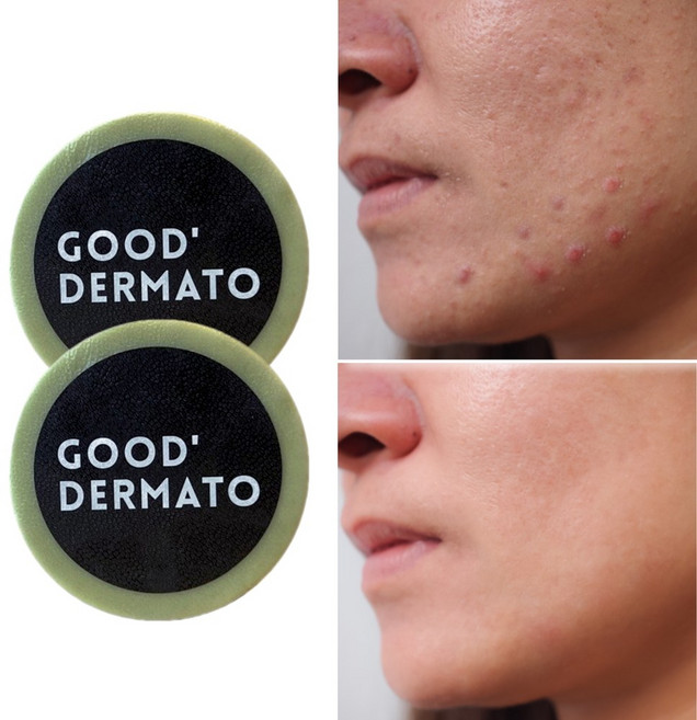 굿더마토 모공필링비누 115g (모공속 피지노폐물 99.9 뿌리까지 딥클렌징. 모공딥클렌징비누 지성피부 문제성피부 천연비누 수제비누), 2개