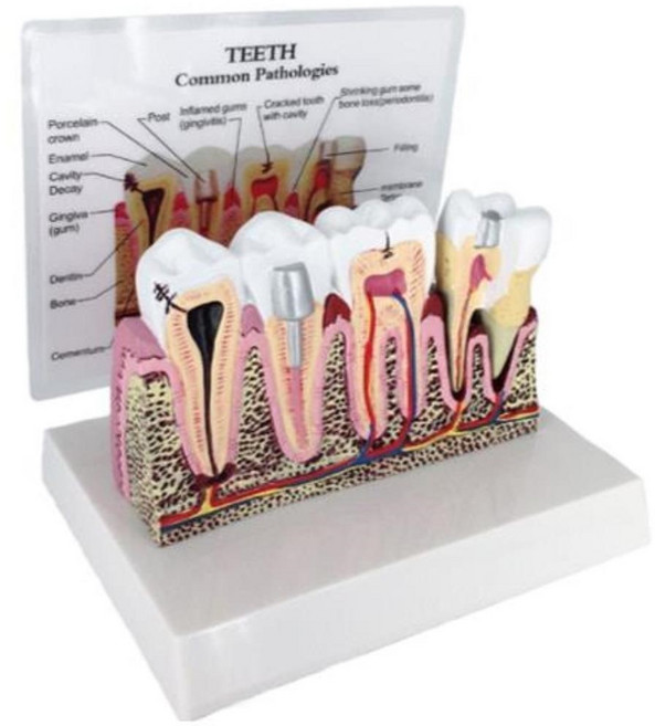사람 충치 치석 정밀관찰 단면 치아모형 치과교육용치아모형 뼈모양 구조관찰, 1세트
