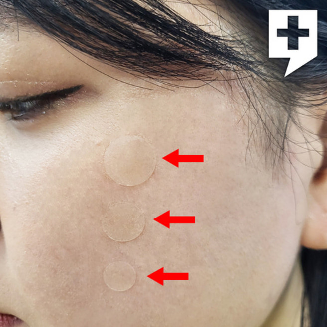 카미케어 여드름패치 습윤밴드 진물 뷰티 흉터 상처 방수 여드름밴드, 5) 카미케어 혼합형 1장, 1개