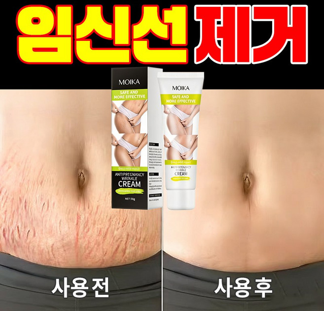 산후 임신주름 제거 비만주름 청소년 성장주름 케어 크림, 1개, 50g