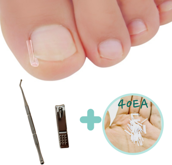 내성발톱 자가치료 셀프 관리 보조기 케어 도구 큐렛 스틱 40개, 1개