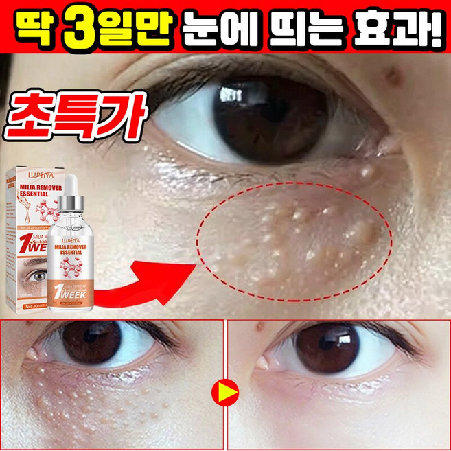 [효과보장] 1/1+1/2+2 눈밑 지방제거 에센스 비립종 제거 앰플 피부요철 각질제거 눈가주름 개선 다크서클 눈밑꺼짐 아이백 아이크림 LUPEIYA, 1개, 30ml