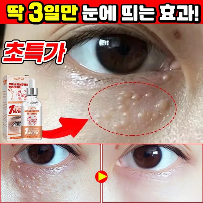 [효과보장] 1/1+1/2+2 눈밑 지방제거 에센스 비립종 제거 앰플 피부요철 각질제거 눈가주름 개선 다크서클 눈밑꺼짐 아이백 아이크림 LUPEIYA, 1개, 30ml - 쿠팡
