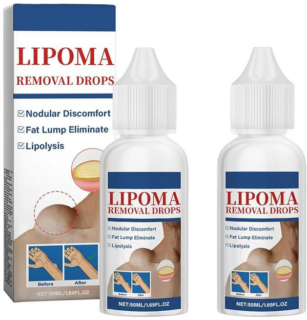 허브 지방종 제거 드롭 제거 크림 완벽한 피부 만들기 50ML/1.69FL.OZ (2개), 허브 지방종 제거 드롭, 제거, 크림, 완벽한 피부 만